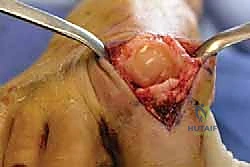 صورة توضيحية لـ تيبس إبهام القدم: حلول متقدمة لآلام المفصل وتقنية Arthrosurface HemiCAP مع الأستاذ الدكتور محمد هطيف