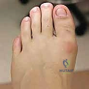 مراحل تطور تيبس إبهام القدم