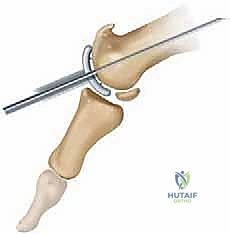 تأثير الالتهابات على مفصل الإبهام