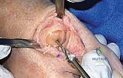 صورة توضيحية لـ تيبس إبهام القدم: حلول متقدمة لآلام المفصل وتقنية Arthrosurface HemiCAP مع الأستاذ الدكتور محمد هطيف