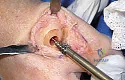 صورة طبية: تيبس إبهام القدم: حلول متقدمة لآلام المفصل وتقنية Arthrosurface HemiCAP مع الأستاذ الدكتور محمد هطيف