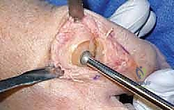 تيبس إبهام القدم: حلول متقدمة لآلام المفصل وتقنية Arthrosurface HemiCAP مع الأستاذ الدكتور محمد هطيف