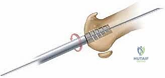 حقن المفصل لتقليل الالتهاب