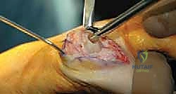 صورة توضيحية لـ تيبس إبهام القدم: حلول متقدمة لآلام المفصل وتقنية Arthrosurface HemiCAP مع الأستاذ الدكتور محمد هطيف