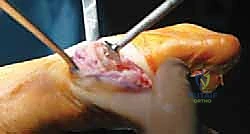 صورة طبية: تيبس إبهام القدم: حلول متقدمة لآلام المفصل وتقنية Arthrosurface HemiCAP مع الأستاذ الدكتور محمد هطيف