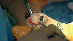 صورة توضيحية لـ تيبس إبهام القدم: حلول متقدمة لآلام المفصل وتقنية Arthrosurface HemiCAP مع الأستاذ الدكتور محمد هطيف