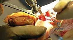 صورة طبية: تيبس إبهام القدم: حلول متقدمة لآلام المفصل وتقنية Arthrosurface HemiCAP مع الأستاذ الدكتور محمد هطيف