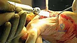 صورة توضيحية لـ تيبس إبهام القدم: حلول متقدمة لآلام المفصل وتقنية Arthrosurface HemiCAP مع الأستاذ الدكتور محمد هطيف