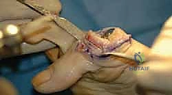 صورة طبية: تيبس إبهام القدم: حلول متقدمة لآلام المفصل وتقنية Arthrosurface HemiCAP مع الأستاذ الدكتور محمد هطيف