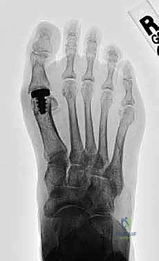 صورة طبية: تيبس إبهام القدم: حلول متقدمة لآلام المفصل وتقنية Arthrosurface HemiCAP مع الأستاذ الدكتور محمد هطيف