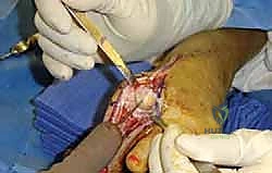 الأشعة السينية تظهر النتوءات العظمية