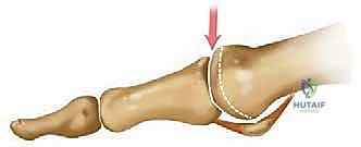 صورة طبية: تيبس إبهام القدم: حلول متقدمة لآلام المفصل وتقنية Arthrosurface HemiCAP مع الأستاذ الدكتور محمد هطيف