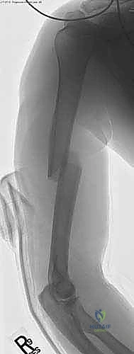 صورة توضيحية لـ علاج كسر عظم العضد بالمسمار النخاعي الأمامي: دليل شامل للمرضى مع الأستاذ الدكتور محمد هطيف