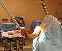 صورة توضيحية لـ علاج كسر عظم العضد بالمسمار النخاعي الأمامي: دليل شامل للمرضى مع الأستاذ الدكتور محمد هطيف