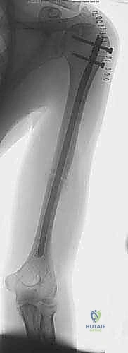 علاج كسر عظم العضد بالمسمار النخاعي الأمامي: دليل شامل للمرضى مع الأستاذ الدكتور محمد هطيف