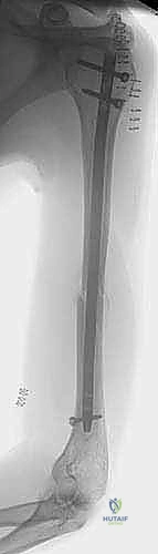 صورة توضيحية لـ علاج كسر عظم العضد بالمسمار النخاعي الأمامي: دليل شامل للمرضى مع الأستاذ الدكتور محمد هطيف