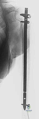 Illustration of proximal to the olecranon - Dr. Mohammed Hutaif