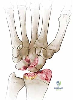 صورة توضيحية لـ استئصال القطب البعيد للعظم الزورقي لعلاج متلازمة SNAC الرسغ: دليل شامل للمرضى مع الأستاذ الدكتور محمد هطيف