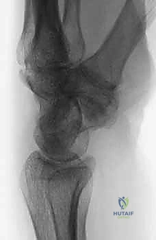 موقع العظم الزورقي في الرسغ