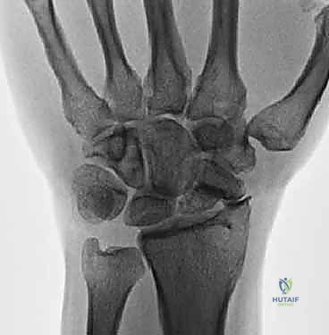 صورة توضيحية لـ استئصال القطب البعيد للعظم الزورقي لعلاج متلازمة SNAC الرسغ: دليل شامل للمرضى مع الأستاذ الدكتور محمد هطيف