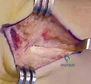 أعراض متلازمة SNAC