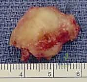 أسباب عدم التئام العظم الزورقي