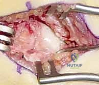 التخطيط الجراحي لعملية الرسغ