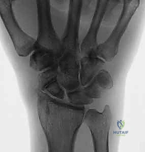 مراحل متلازمة SNAC