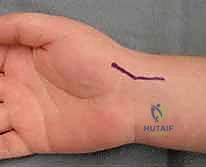 تآكل الغضاريف في متلازمة SNAC