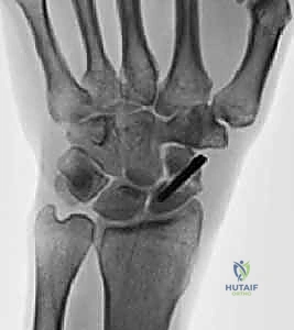 Intraoperative Surgical Step