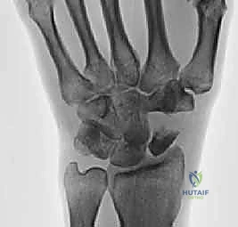 Distal Scaphoid Pole Excision for Scaphoid Nonunion Advanced Collapse (SNAC) Wrist: An Intraoperative Masterclass