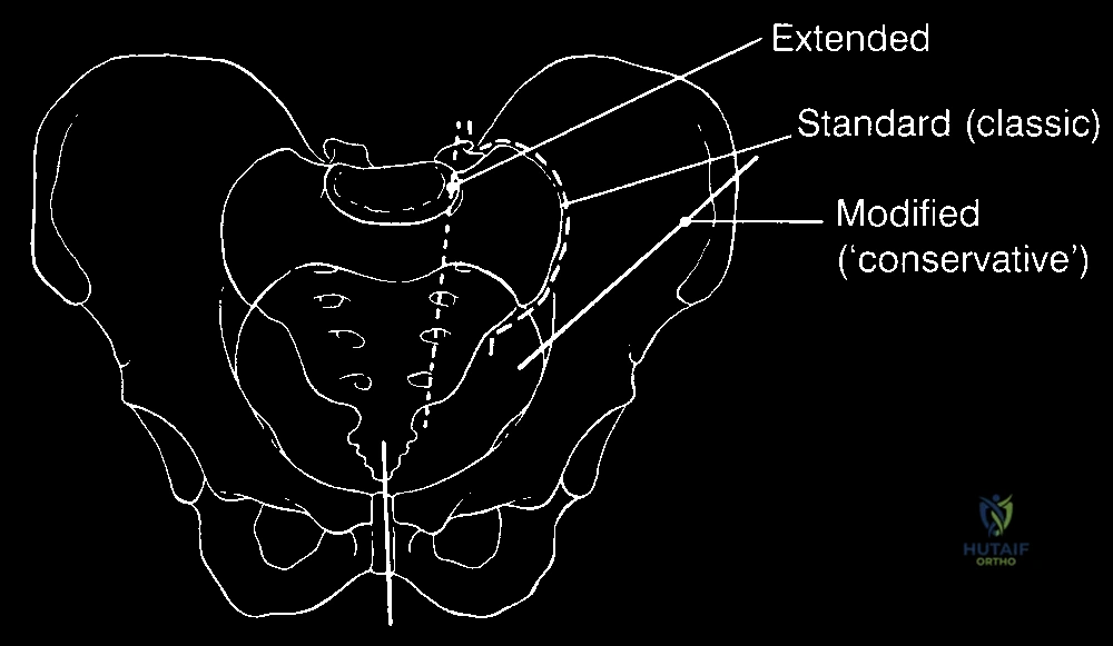 أورام الحوض العدوانية