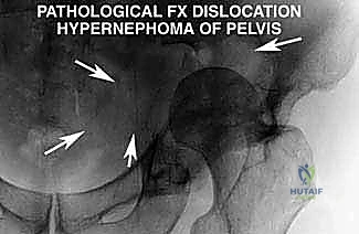 الشق الجراحي الخلفي ورفع السديلة