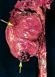 تحديد هوامش الاستئصال