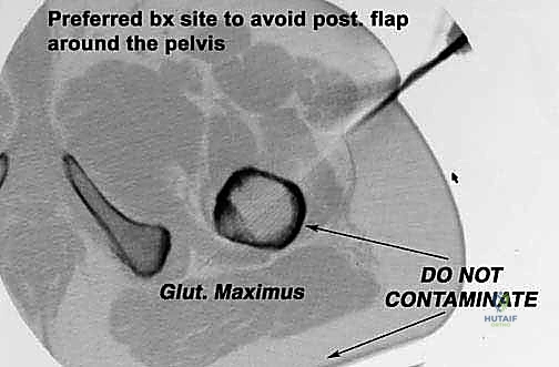 إغلاق الجرح باستخدام السديلة الخلفية