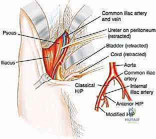 صورة توضيحية لـ عملية بتر النصف الحوضي الخلفي: دليل شامل للمرضى مع الأستاذ الدكتور محمد هطيف في صنعاء