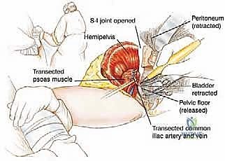صورة توضيحية لـ عملية بتر النصف الحوضي الخلفي: دليل شامل للمرضى مع الأستاذ الدكتور محمد هطيف في صنعاء