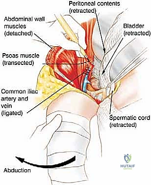 التحضير للعملية الجراحية