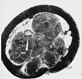 قص العظام وفصل الحوض