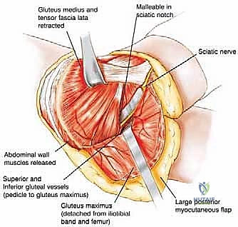 تشريح الحوض المعقد