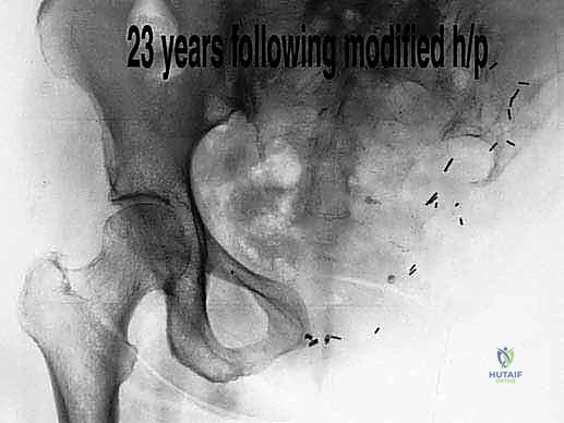 عملية بتر النصف الحوضي الخلفي: دليل شامل للمرضى مع الأستاذ الدكتور محمد هطيف في صنعاء