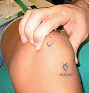 إعادة توجيه الرضفة: علاج عدم استقرار مفصل الرضفة الفخذي جراحياً في صنعاء مع الأستاذ الدكتور محمد هطيف