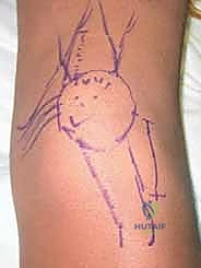 صورة توضيحية لـ إعادة توجيه الرضفة: علاج عدم استقرار مفصل الرضفة الفخذي جراحياً في صنعاء مع الأستاذ الدكتور محمد هطيف