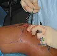 صورة توضيحية لـ إعادة توجيه الرضفة: علاج عدم استقرار مفصل الرضفة الفخذي جراحياً في صنعاء مع الأستاذ الدكتور محمد هطيف