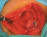 التخطيط الجراحي لإعادة بناء الرباط الرضفي الفخذي الإنسي