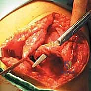 التشريح الدقيق لمفصل الرضفة الفخذي والرباط الرضفي الفخذي الإنسي