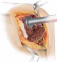 توضيح الفجوات العظمية في عظم الفخذ قبل الجراحة