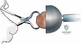 صورة توضيحية لـ جراحة مراجعة مفصل الركبة الكلي: التغلب على فقدان عظم الفخذ باستخدام الدعامات والطعوم العظمية