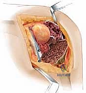 تجهيز واستخدام الطعوم العظمية أثناء الجراحة