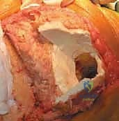 صورة شعاعية للمفصل النهائي بعد التثبيت